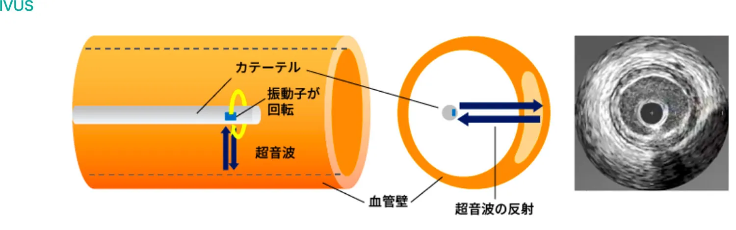 循環器内科-IVUS