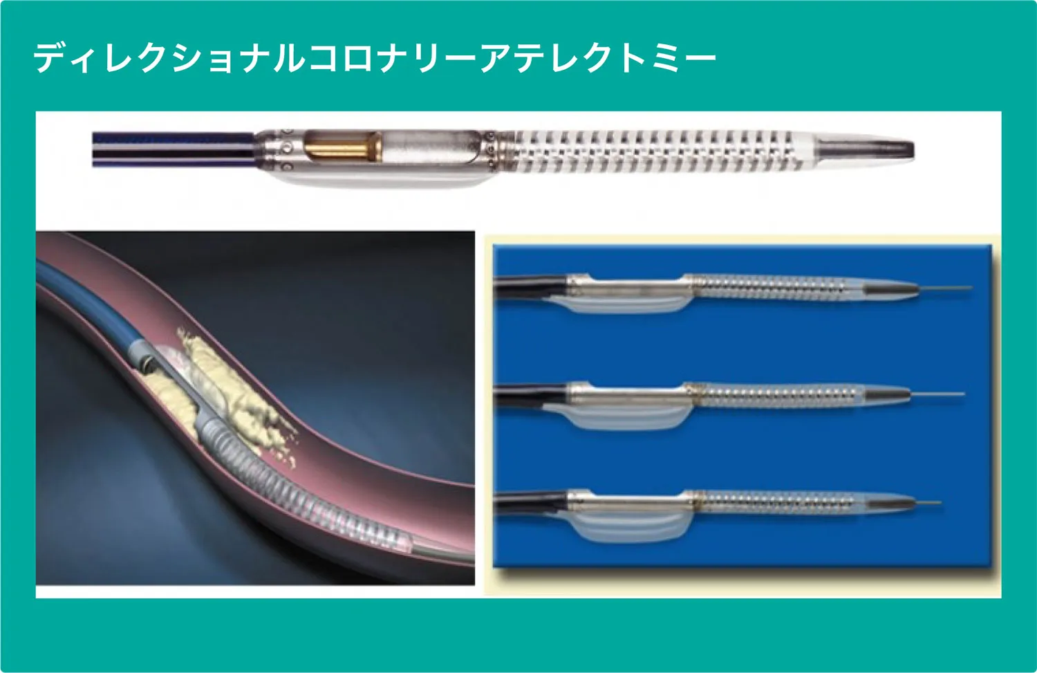 循環器内科-ディレクショナルコロナリーアテレクトミー