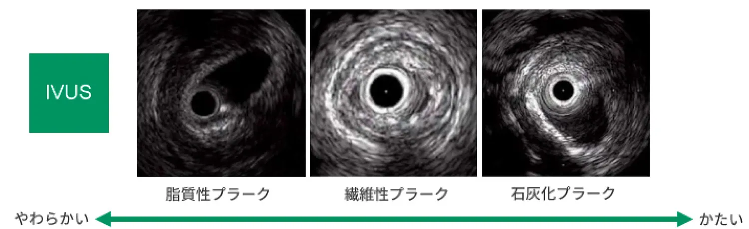 循環器内科-IVUS2