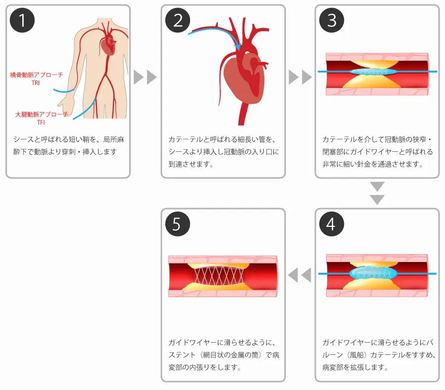 循環器内科-PCI