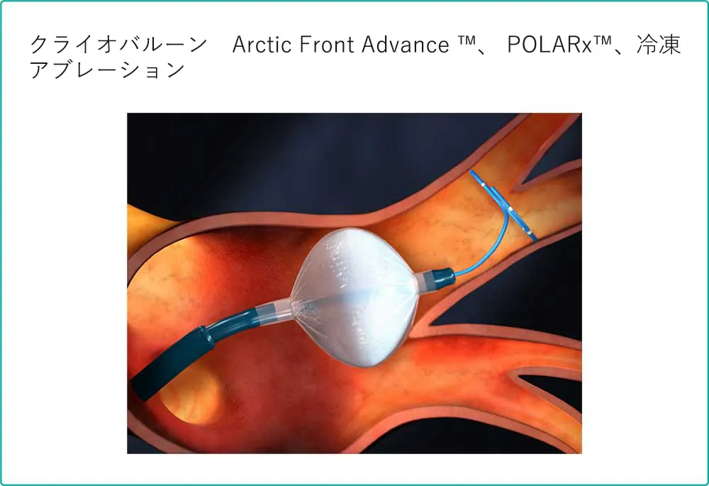 循環器内科-バルーンアブレーション①