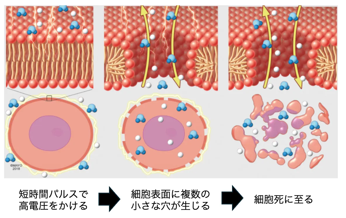 循環器内科-パルスフィールドアブレーションの原理