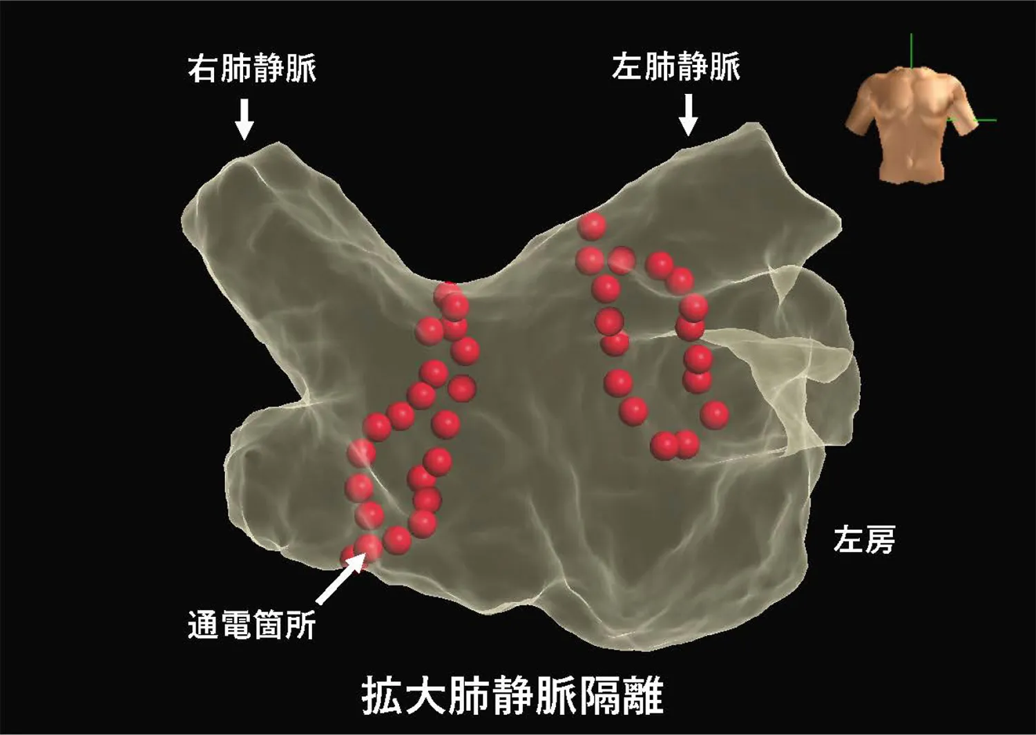 循環器内科-拡大肺静脈隔離