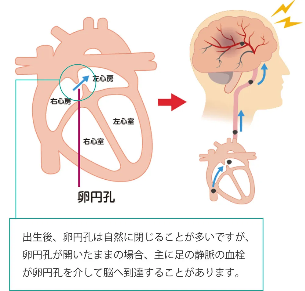 循環器内科-経カテーテル卵円孔閉鎖術