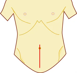 ロボット支援下大腸切除術⑤