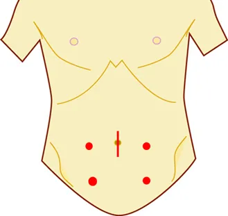 ロボット支援下大腸切除術⑥
