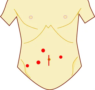 ロボット支援下大腸切除術⑦