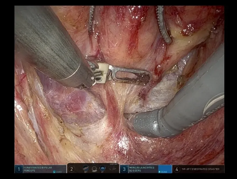 ロボット支援下大腸切除術⑨