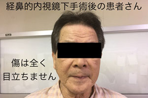 脳神経外科-経鼻内視鏡下手術術後の経過②