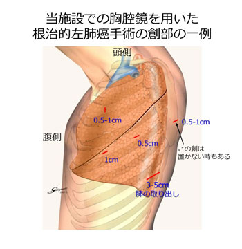 胸腔鏡手術について02