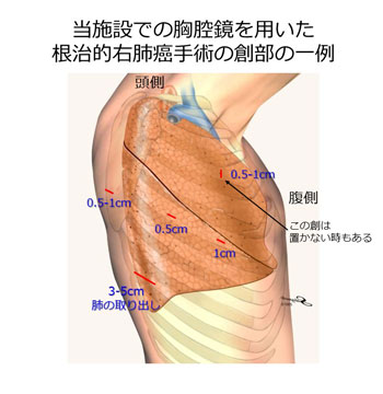 胸腔鏡手術について01