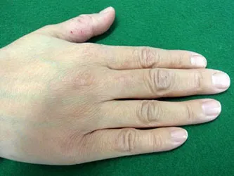 尋常性疣贅の治療④