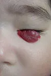 無治療によるリスクを伴う乳児血管腫の発症部位-顔面