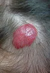 無治療によるリスクを伴う乳児血管腫の発症部位-頭皮