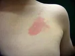 無治療によるリスクを伴う乳児血管腫の発症部位-毛細血管