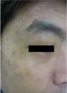 扁平疣贅の治療前後②