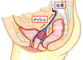 産婦人科でのロボット支援下手術②