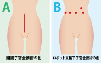 産婦人科でのロボット支援下手術③