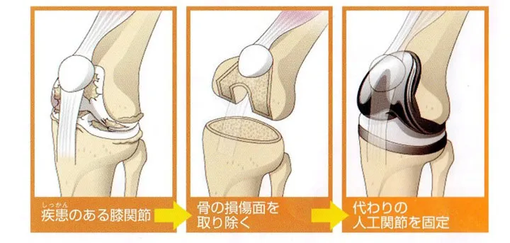整形外科ー人工膝関節置換術①