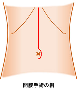 開腹手術の創