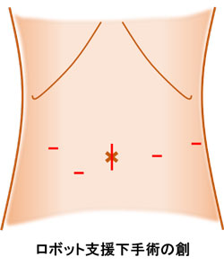ロボット支援手術の創