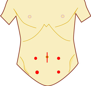 ②腹腔鏡下手術